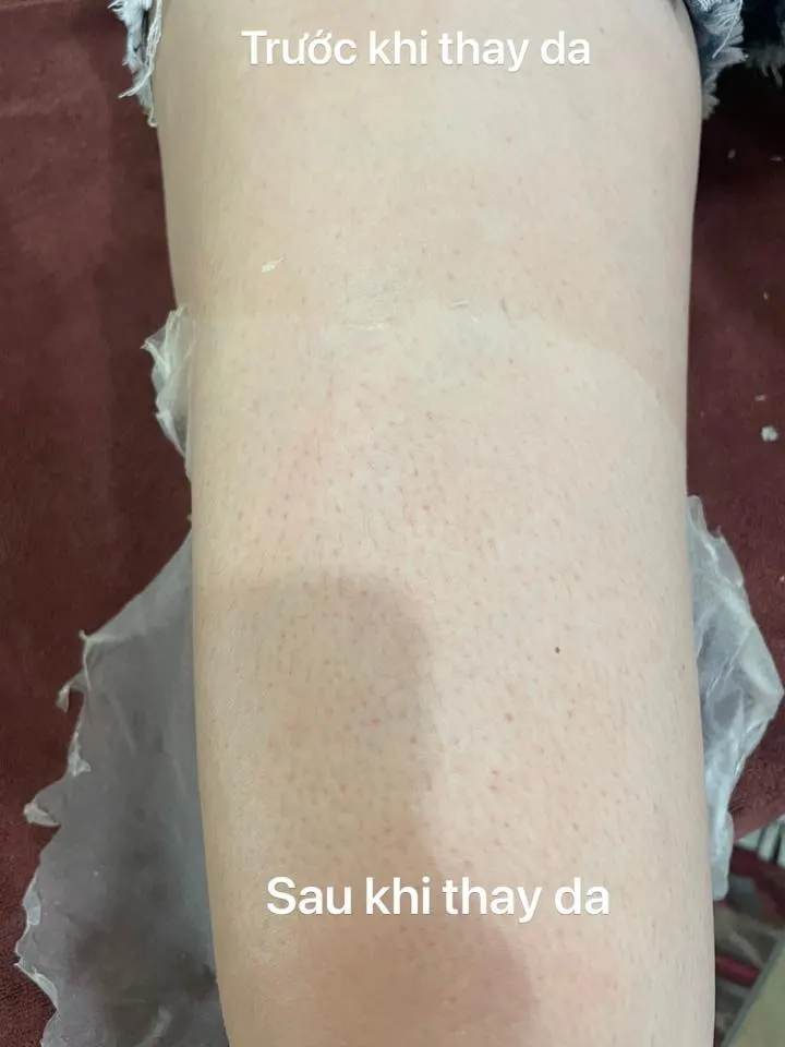 Thay Da Sinh Học Tại Nhà: Bí Quyết 'Lột Xác' An Toàn Cho Mẹ Bỉm Sữa?